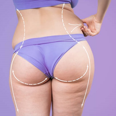 Buttock Augmentation in Islamabad Pakistan