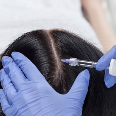 Hair Fillers for Baldness in Islamabad, Rawalpindi & Pakistan