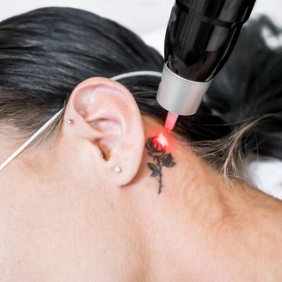 Laser Tattoo Removal in Islamabad