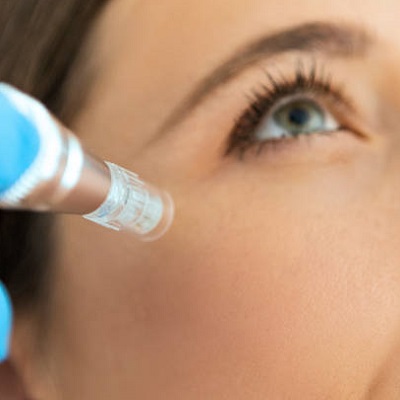 Microneedling treatment in Islamabad, Rawalpindi & Pakistan