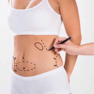 Tummy Tuck treatment in Islamabad, Rawalpindi & Pakistan