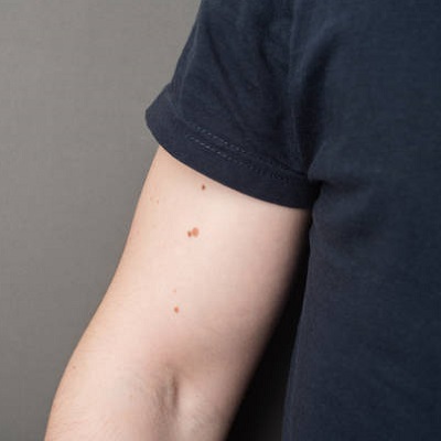 laser birthmark removal in islamabad rawalpindi Pakistan