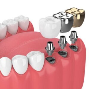 3 types of dental implants in islamabad