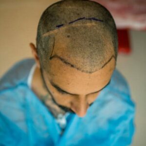 Are people happy with a hair transplant?