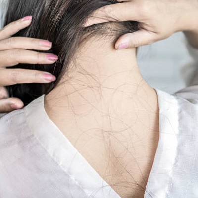 Baldness Treatment for Women in Islamabad