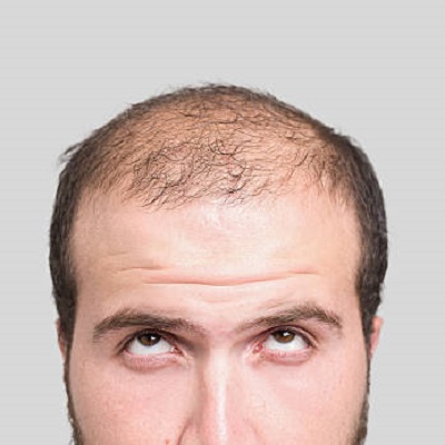 Exosomes For Hair Loss Price In Pakistan