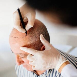 From Bald to Bold: The Remarkable Results of Hair Transplant Surgery