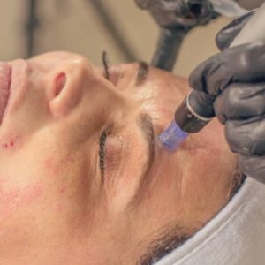 How many microneedling treatment sessions do I need to see results?