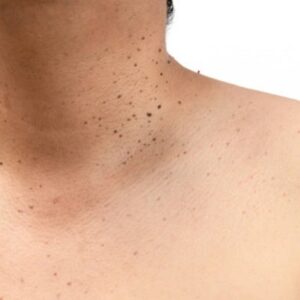 How to Prevent Skin Tags from Forming in the First Place