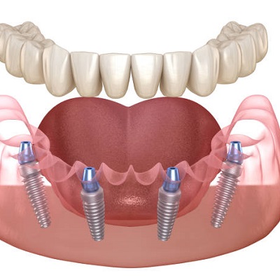 The Perfect Fit Exploring Dental Implants