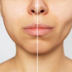 The Power of Buccal Fat Removal