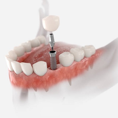 The Role of Technology in Dental Implantology Advancements and Benefits