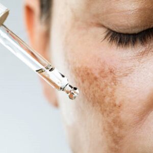 Understanding the Differences between Melasma and Hyperpigmentation