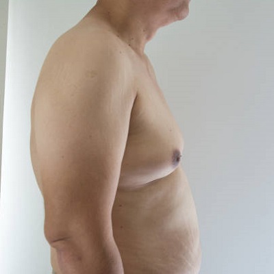 What are the best treatments for Gynecomastia