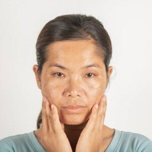 What is the best way to tackle melasma on the face?