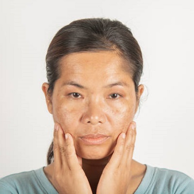 What is the best way to tackle melasma on the face