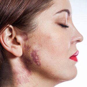 What is the cost of birthmark removal treatment in Pakistan?