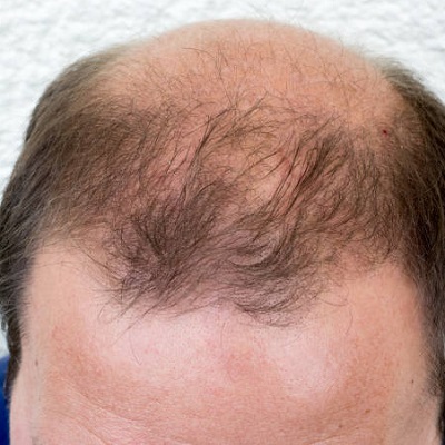 What is the cost of the crown hair transplants in Pakistan