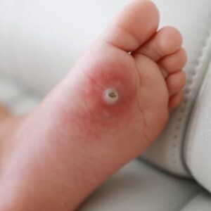 Why warts should be removed?