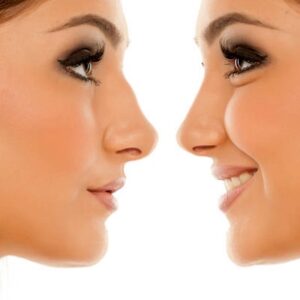 Will people be able to notice my rhinoplasty?