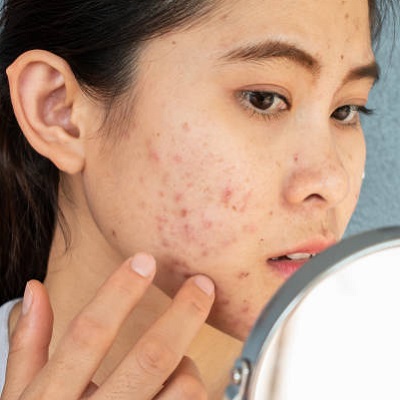 acne scar treatment for face