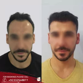 Hair transplant Before after SKN Cosmetics