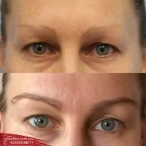 Results of Eyebrow hair transplant