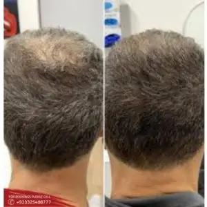 results of Exosomes hair therapy