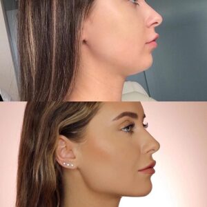 3 Great Things About Jawline Contouring in Islamabad