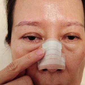 Broken Nose Surgery in Islamabad