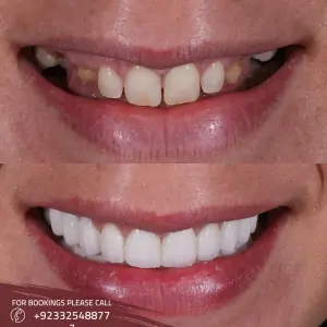 Dental Filling in Islamabad & Rawalpindi, Pakistan