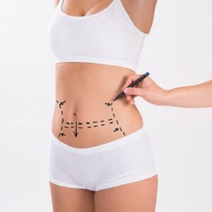 Do I look slim after getting Liposuction Surgery?