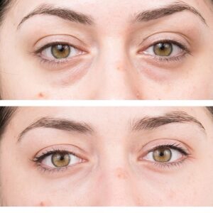 Do eye bags return after surgery?