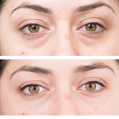 Do eye bags return after surgery?