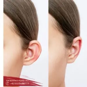 Ear Surgery Otoplasty in Islamabad