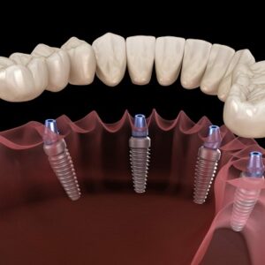 How dental implant surgery recovery be done?