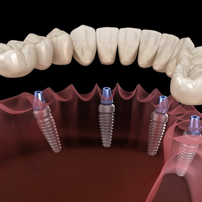 How dental implant surgery recovery be done? | Dental implant