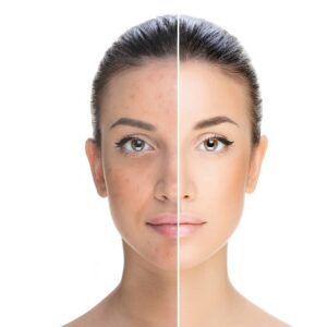 Hyperpigmentation Treatment Tips for Flawless Skin