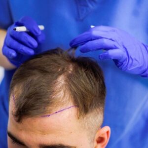 Is it common for my scalp to itch following a hair transplant?