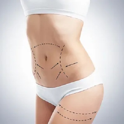 Lipo Abdominoplasty in Islamabad, Rawalpindi & Pakistan