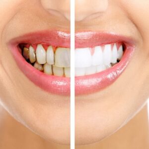 Scale and Smile: A Journey to Improved Dental Health