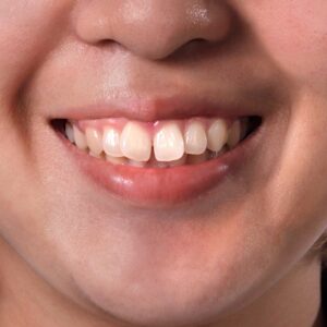 What are protruding teeth and how can a dentist fix them?